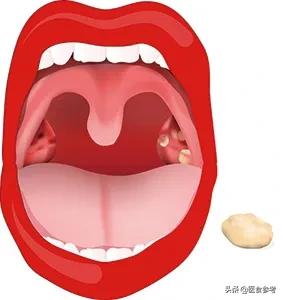 咽部有异物感咳出小肉球,咽部异物感引发咳嗽