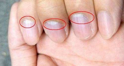 指甲有竖条纹是大病的前兆吗,指甲出现褐色竖纹代表什么病