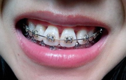 戴牙套黑三角可以恢复吗,戴牙套的黑三角可以恢复吗