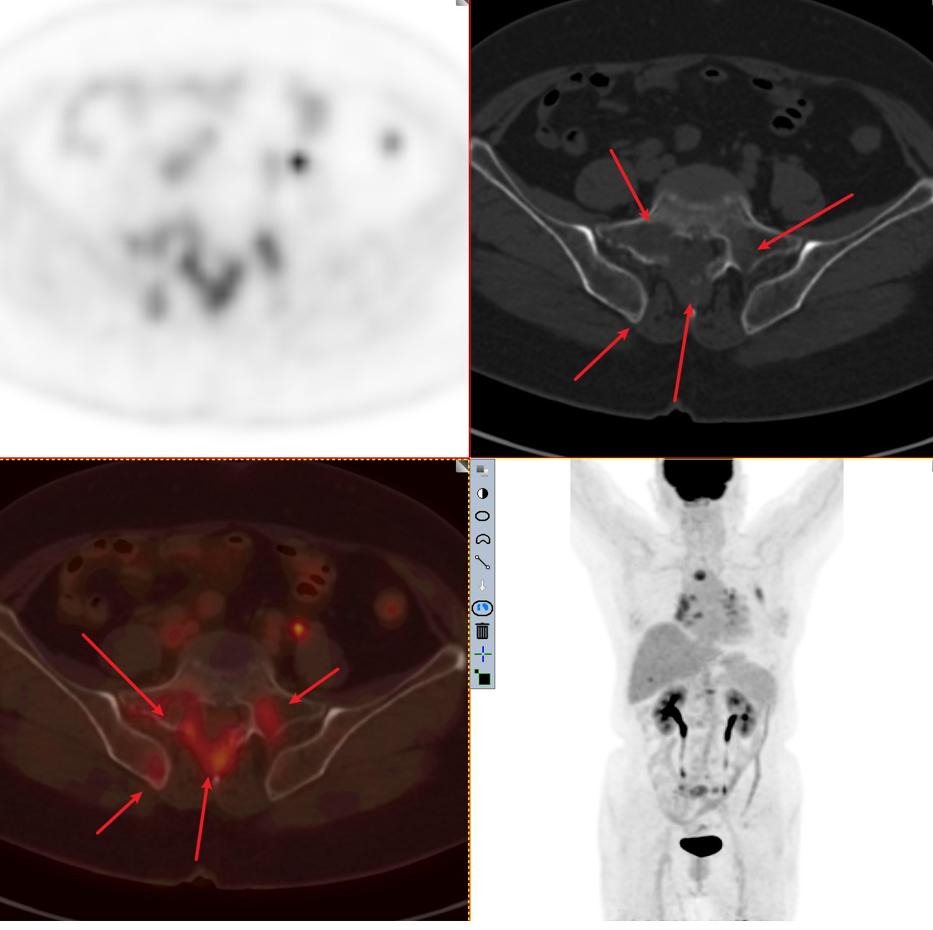肺结节检查是薄层ct还是三维重建,肺结节检查用什么ct