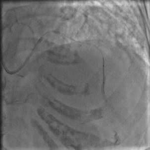 85岁老人心脏堵塞,77岁老人冠脉狭窄放支架还是搭桥
