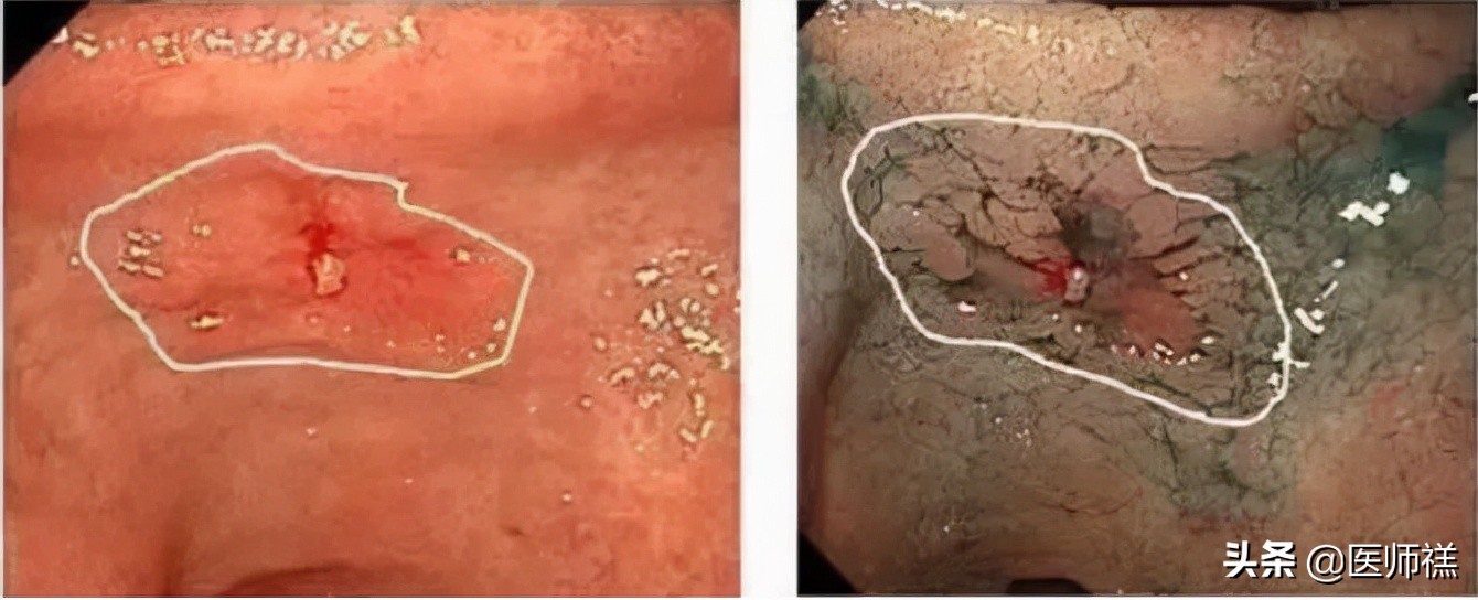 胃炎迁延不愈,胃炎久治不愈需要再做胃镜吗