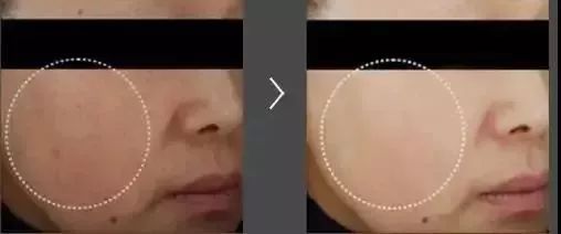 东星祛斑霜为什么火了,东星祛斑霜是真的吗