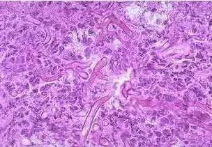 尴尬！用避孕套竟患霉菌性阴道炎