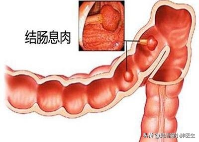 结肠息肉会转癌症吗,结肠息肉属良性肿瘤能变癌吗
