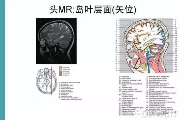 mra头颅解剖学详细讲解视频,常见的头颅mri图像