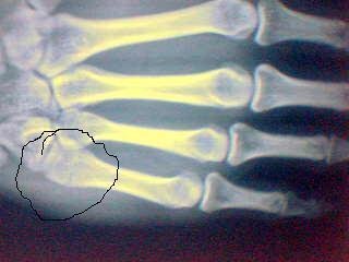 小伙子打架手臂受伤,在酒吧打架手臂受伤