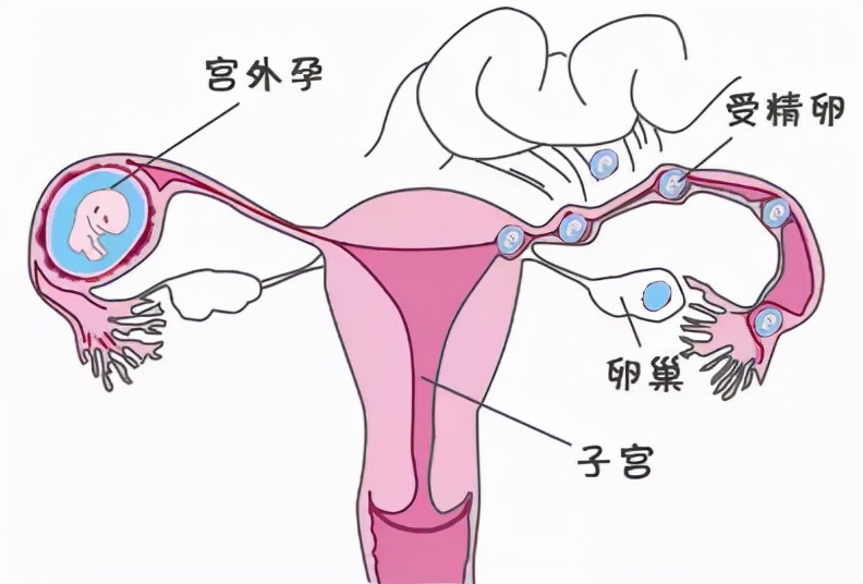 不知道怀孕了怎么避免宫外孕,受孕了怎么才知道有没有宫外孕