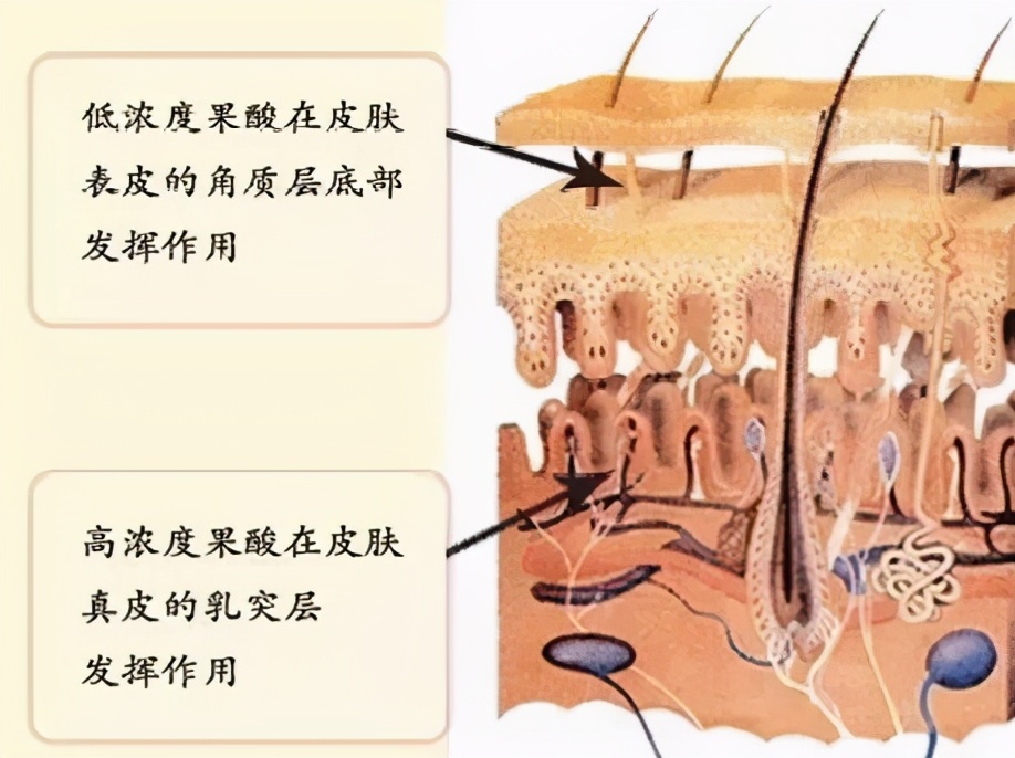 痘肌必看果酸换肤详细指南,果酸换肤对治疗痘痘作用大吗