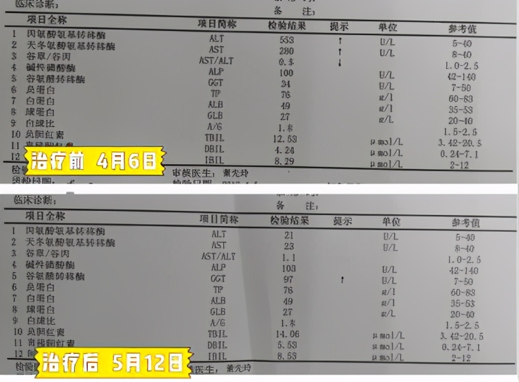 乙肝有康复的案例吗,乙肝康复案例
