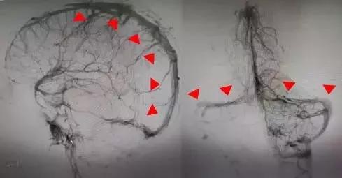 熬夜加班后脑袋疼,26岁小伙熬夜加班后头晕