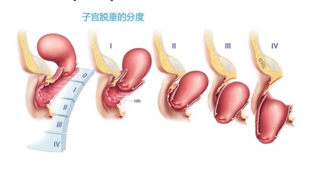 七旬老妪的难言之隐，其实可以这样预防