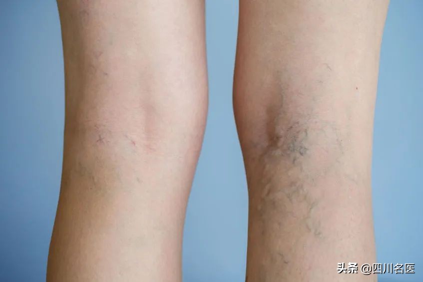 华西专家讲静脉曲张,16岁少年得静脉曲张吗