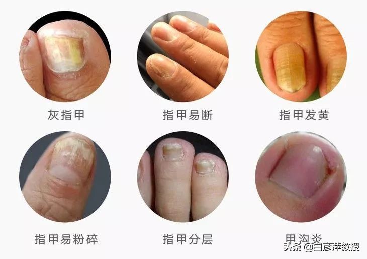 灰指甲是真菌怕晒吗,灰指甲一定是灰色的吗