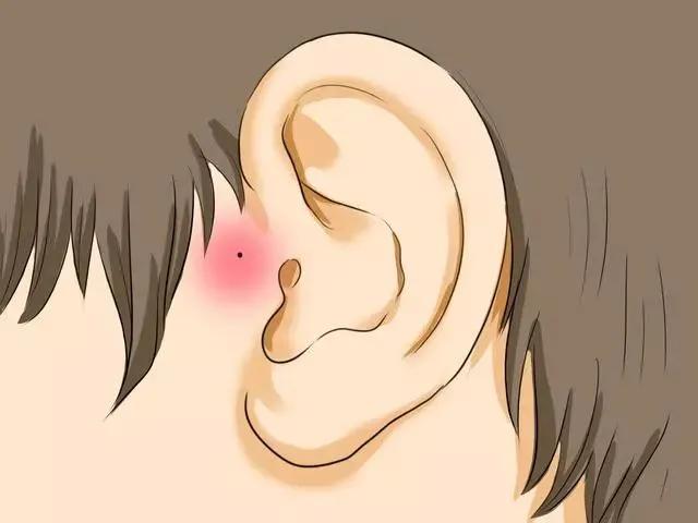 7个月宝宝有耳前瘘管可以手术吗,婴儿耳瘘管切除是大手术吗