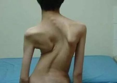 强直女性一般多少岁就不发展了,强直男性和女性有不同吗