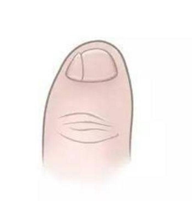 小脚趾分两瓣的人是哪个民族,小脚趾甲分成两半的是纯正汉人么