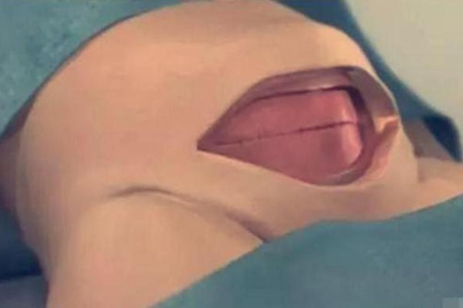 剖腹产肚子上最多能挨几刀,剖腹产完打的肚皮针是什么