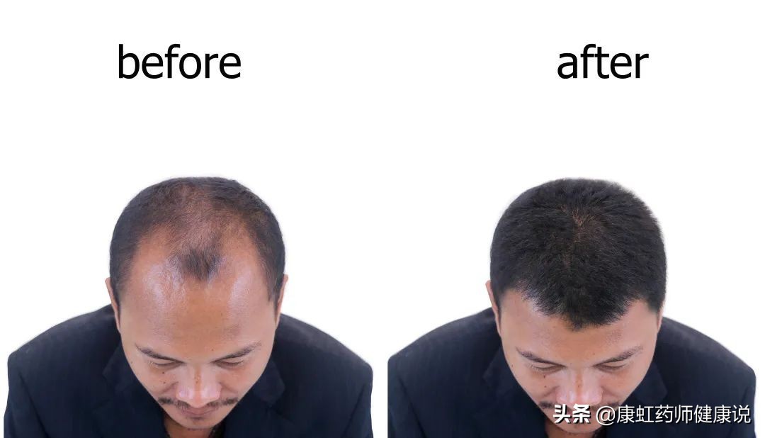 中国有多少人七级脱发,45岁脱发能恢复以前的发量吗