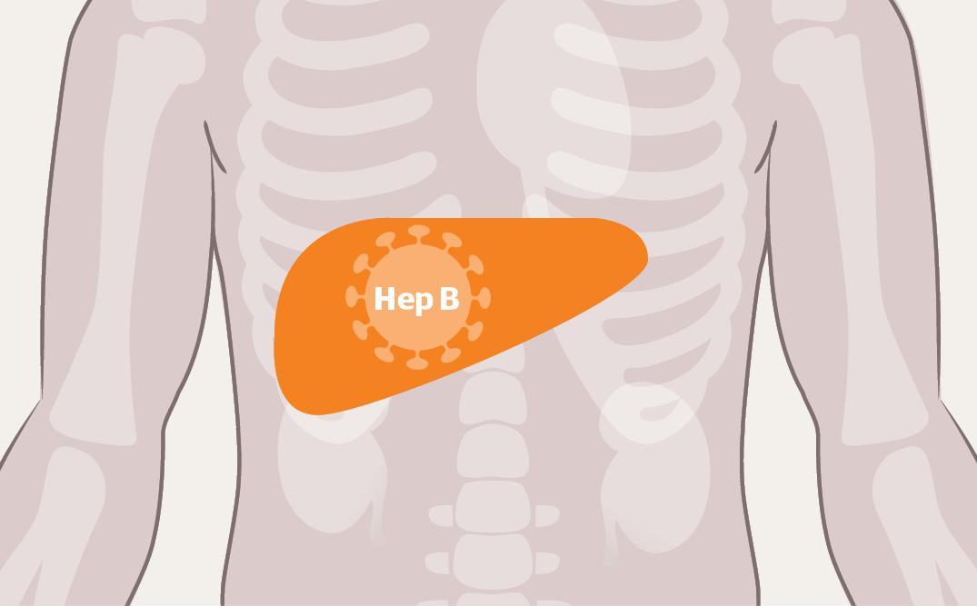 医生,我有乙肝大三阳,吃点什么药?慢性乙肝抗病毒治疗简明指南