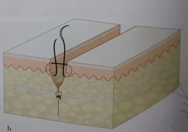 伤口闭合的正确方法,伤口清创的详细步骤