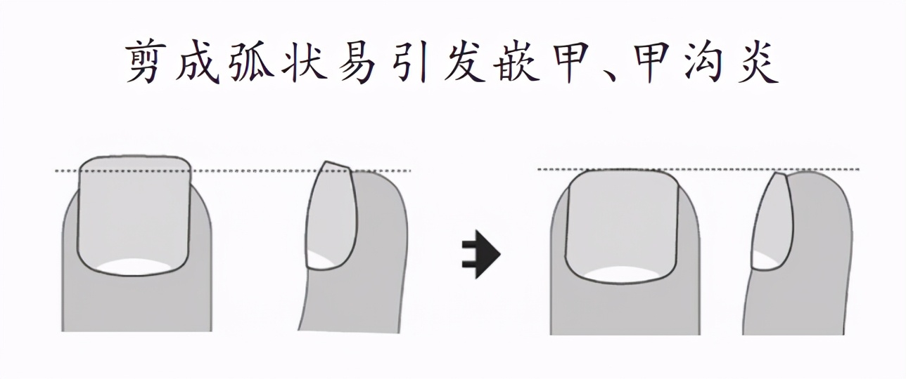 女生指甲太短甲沟炎,指甲剪成什么形状不得甲沟炎