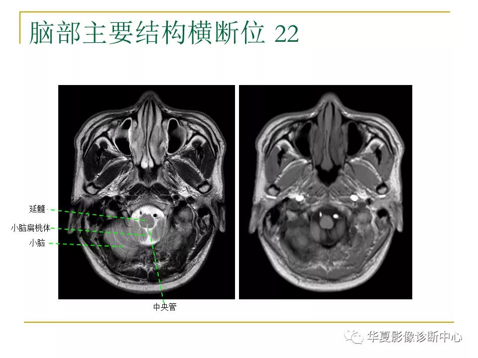 中国人脑立体定向mri应用解剖图谱,脑mri示意图