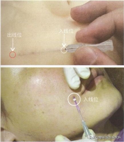 埋过线还能做拉皮吗,面部埋线提升颧骨变得很高怎么办