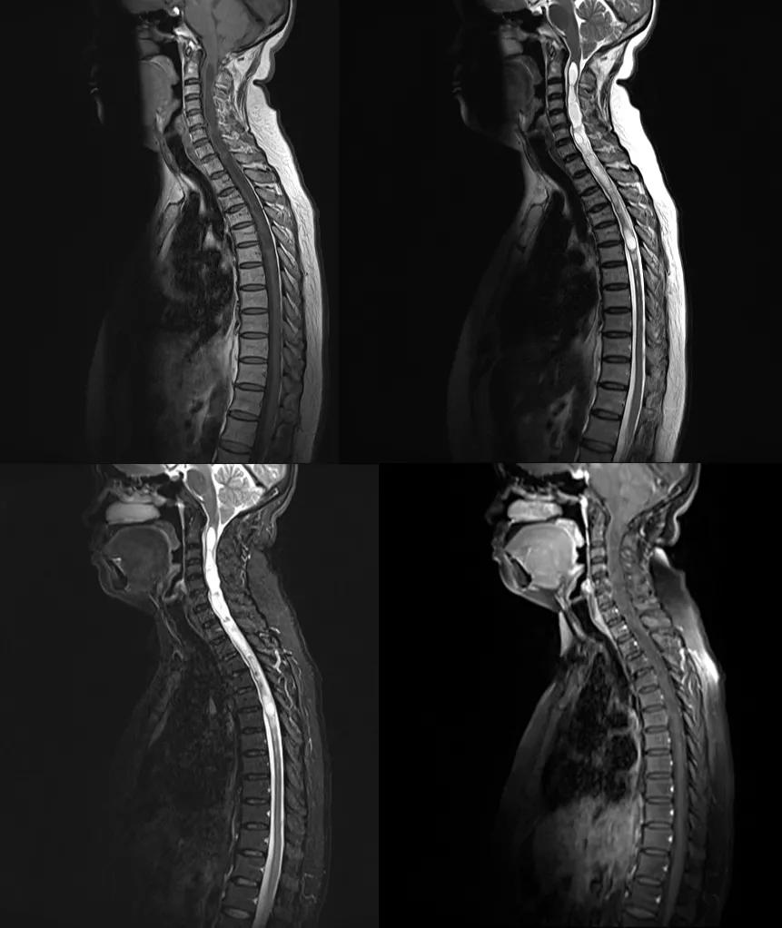 先天性颅脑发育不全,先天颅脑发育不良能治吗