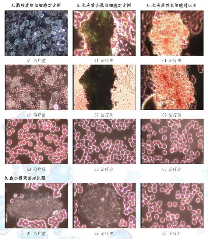 臭氧血疗法对脑梗有用吗,臭氧疗法脑梗塞