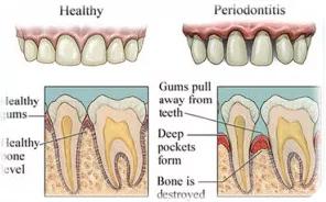 呼呼呼，跟你说话这么大风？原来是你牙齿漏风