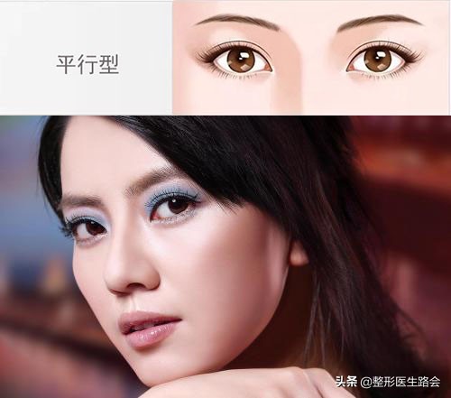 关于双眼皮你应该知道的有哪些,做双眼皮必须知道的三件事