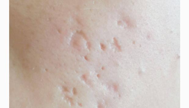 痘痘爆发季告诉你痘痘的形成原因,痘痘长期存在总是爆痘怎么办