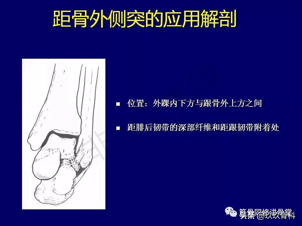 距骨骨折的治疗原则,距骨骨折如何调理