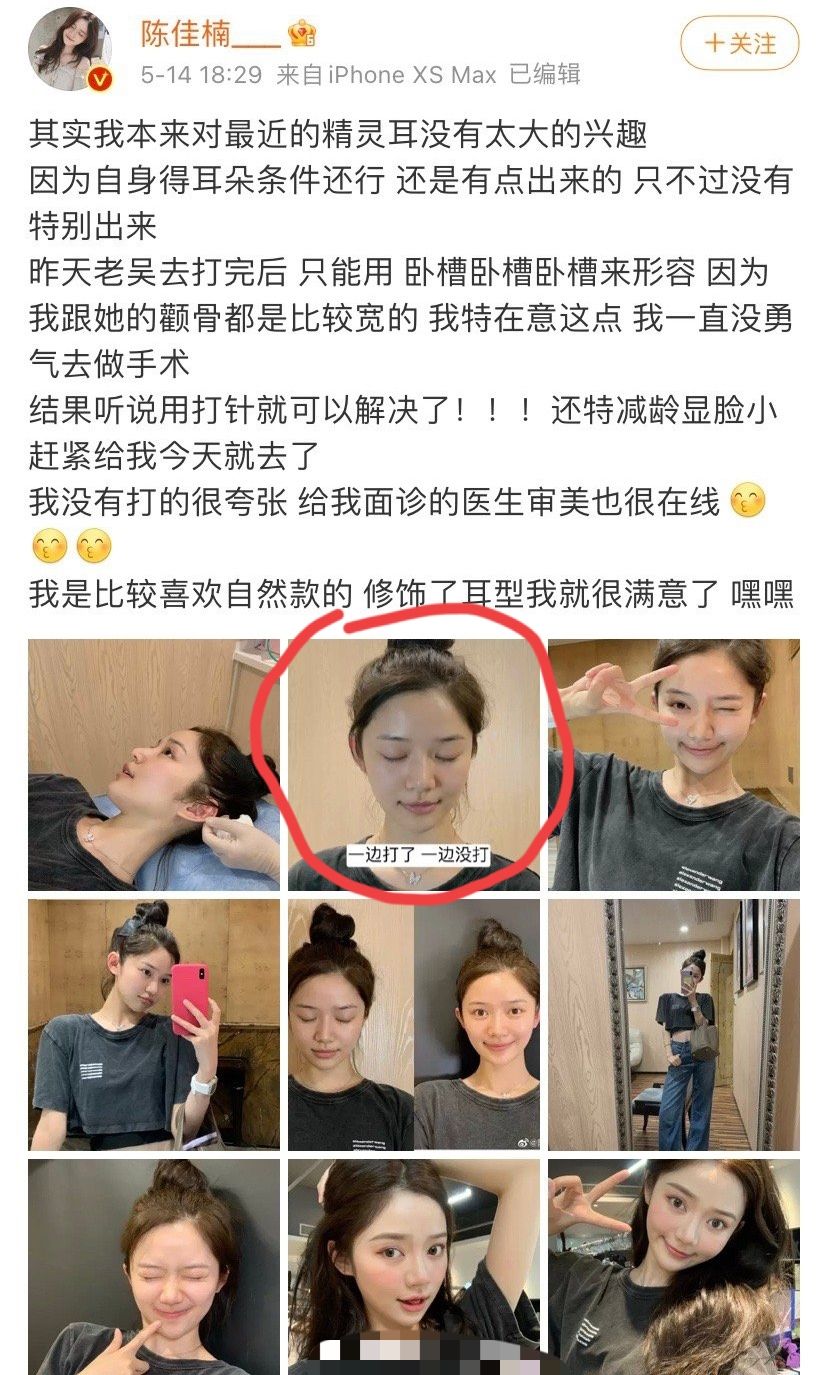 20万玻尿酸,一连打6支玻尿酸会怎么样