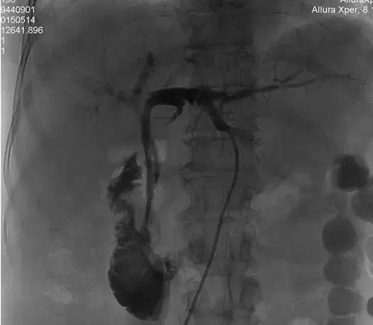 胆管下段良性肿瘤手术治疗方法,恶性肿瘤小肠梗阻介入治疗
