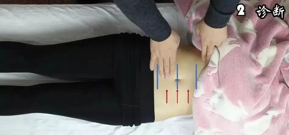 怎么确定是不是腹直肌分离,腹直肌分离到底是怎样的