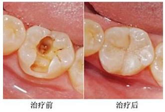 难度大的龋洞修复,龋洞在侧面医生不建议补洞