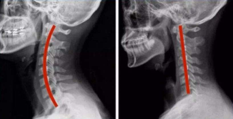 医生,我有颈椎病但不想手术!嗯,你每天跑步就能好,你信不信?