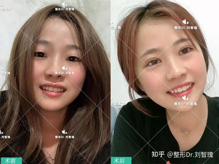 女生割双眼皮大概花多少钱,为啥不建议女生割双眼皮