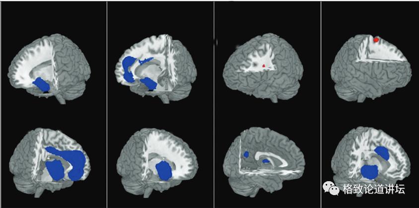 躁郁症误诊率,怎么判断得了躁郁症