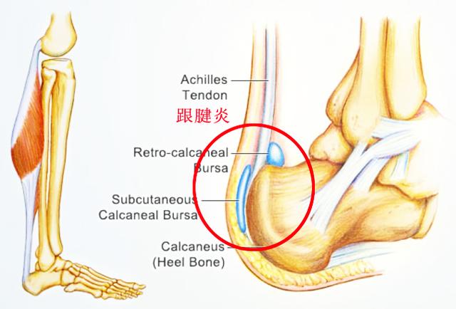 产后足跟痛是什么原因引起的,足跟痛是什么原因用什么贴