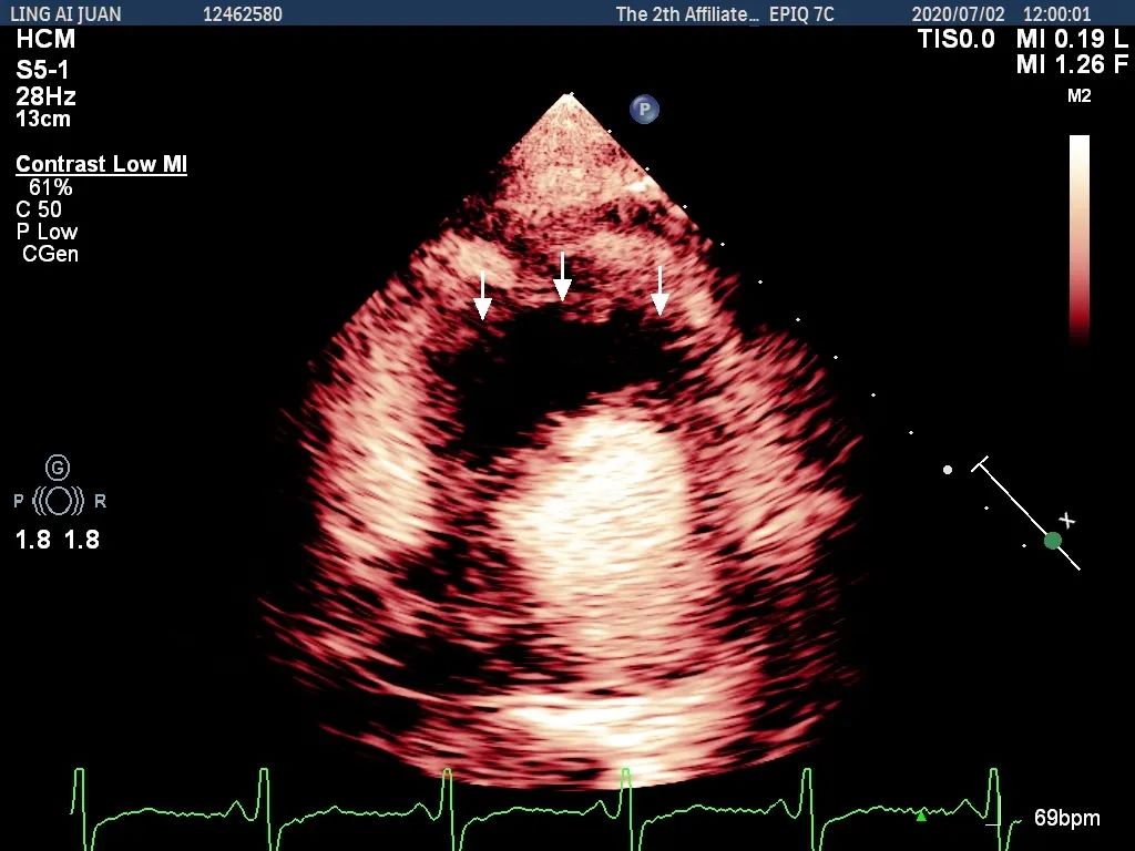 肥厚型非梗阻心肌病吃什么中药,肥厚心肌病非梗阻最新治疗方案