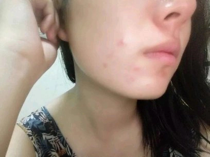 排痘效果好的药膏,祛痘排雷