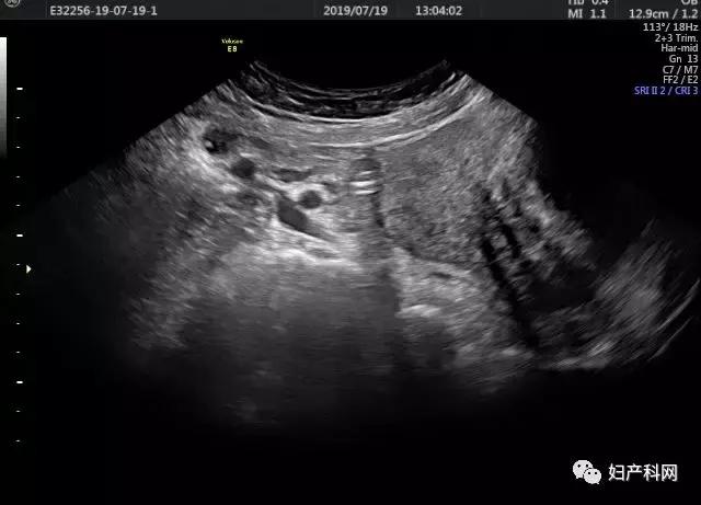 超声介入消融治疗卵巢囊肿,微无创治疗子宫肌瘤过程