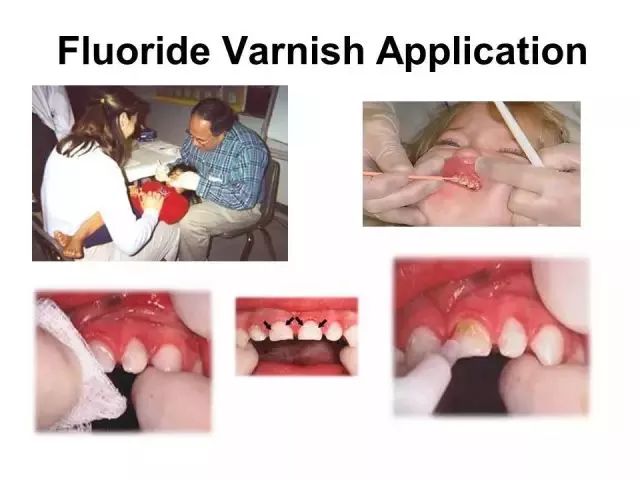 牙齿脱矿龋坏怎么补救,牙齿萎缩蛀牙怎么办