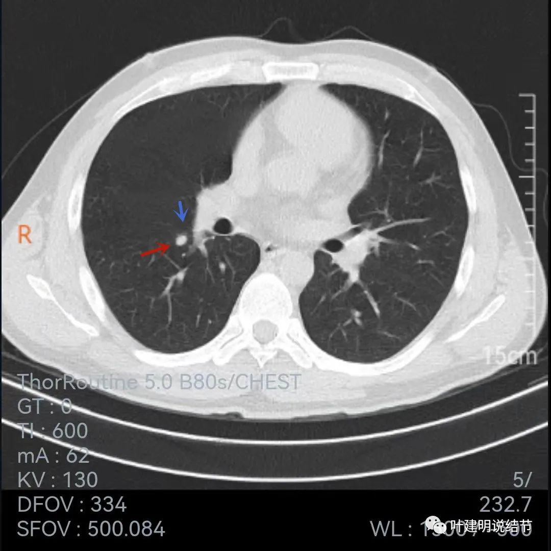 问诊分析：存在了4年的实性结节会不会是肺癌？