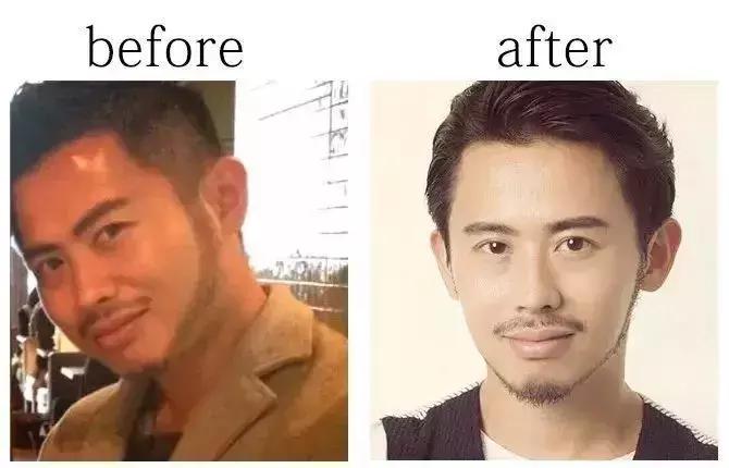 日本小脸矫正手法,日本小脸整形手术