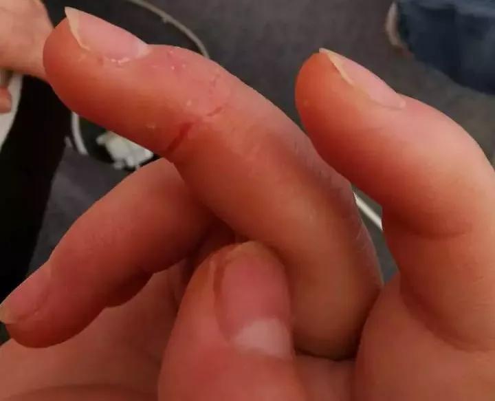 手上脱皮是什么真菌,手上脱皮真菌感染抹什么药膏好