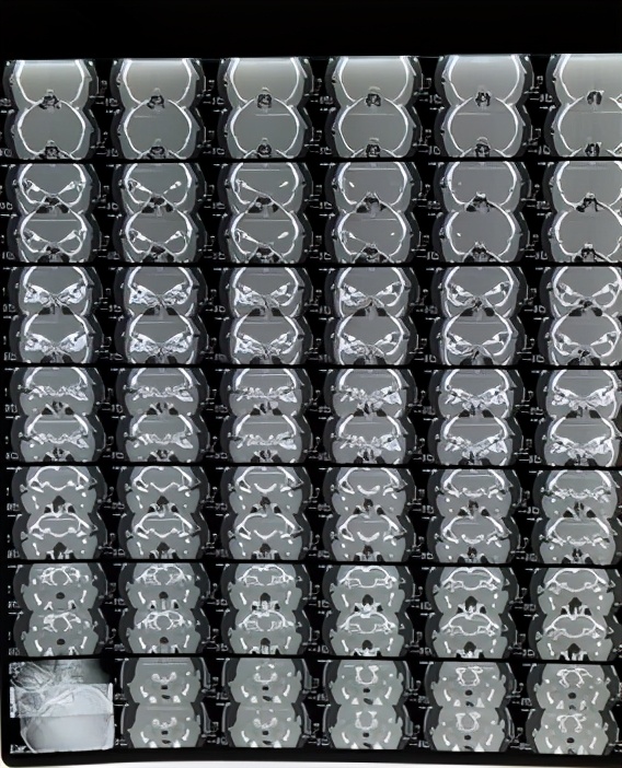 头晕耳鸣听力下降,头晕脑胀听力下降怎么回事